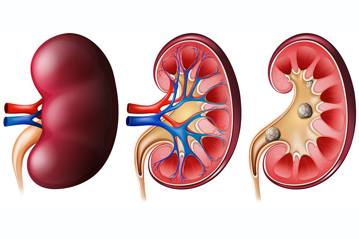 Kidney Stones