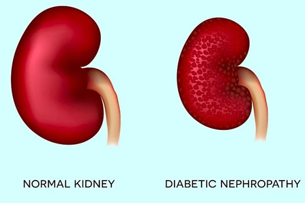 Diabetic Kidney Disease